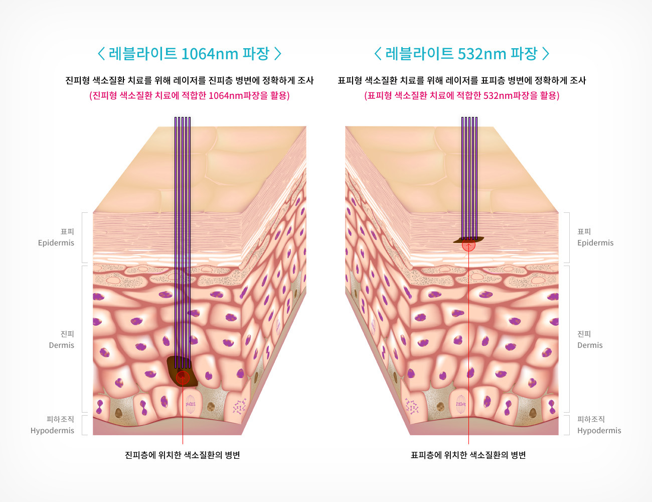 성북구피부과성신여대입구역기미치료 (4).jpg