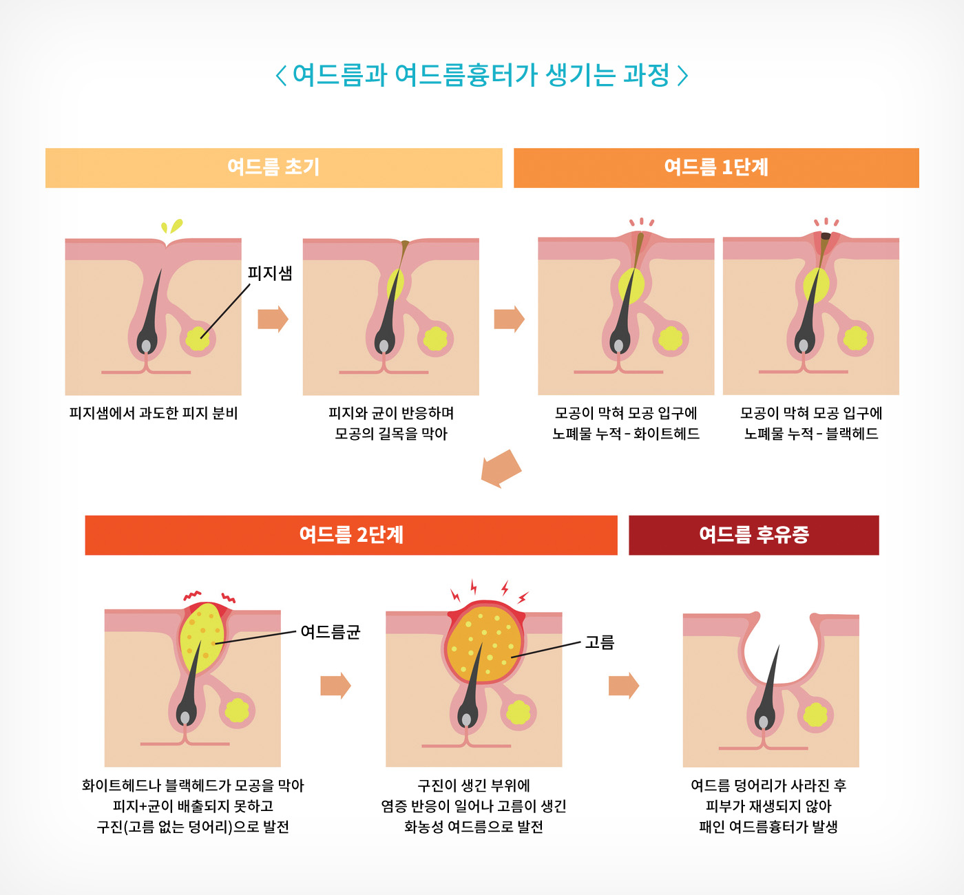 대학로피부과 성신여대 포이즌 (1).jpg
