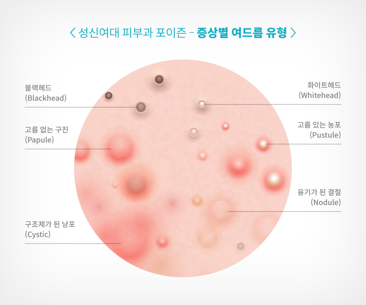 대학로 피부과 피지낭종 표피낭종 (12).jpg