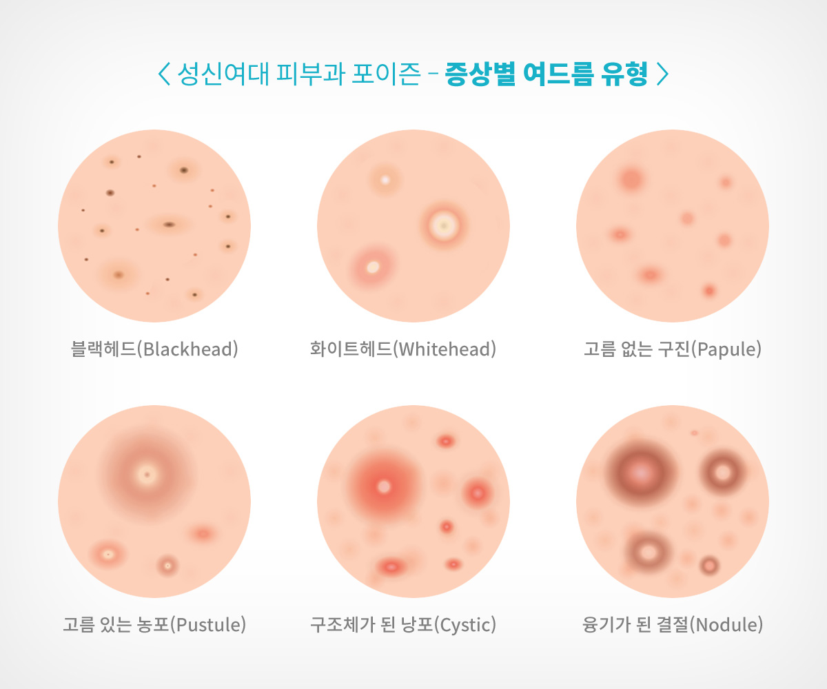 성신여대역 피부과 포이즌 비립종 (5).jpg