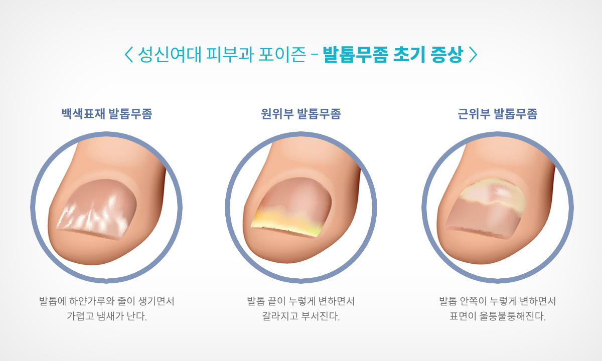 성북구피부과 포이즌발톱무좀 (7).jpg