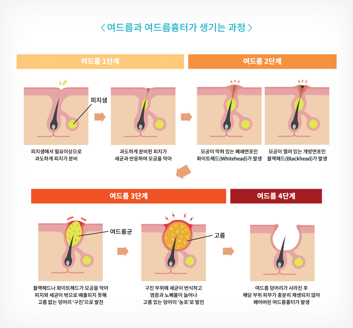 성북구 피부과 성신여대입구역 포이즌 여드름 (12).jpg