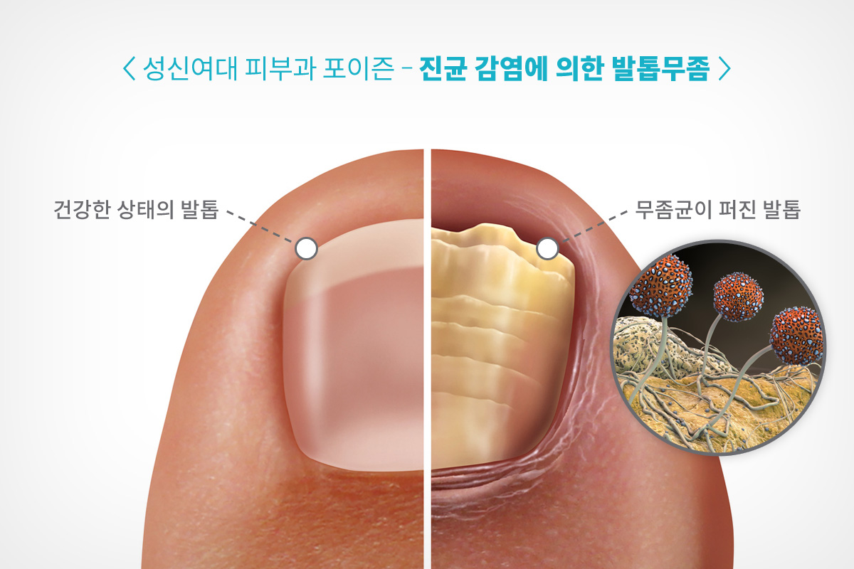 성신여대역 피부과 포이즌 발톱무좀치료 (14).jpg
