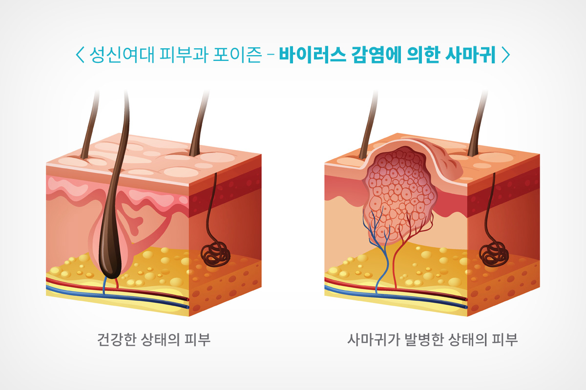 정릉역 피부과 포이즌 사마귀냉동치료 (9).jpg