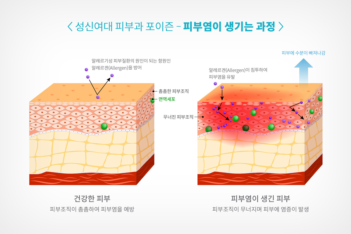 성신여대 피부과 기온이 높아지면 흔하게 나타나는 알레르기성 피부염 - 피부질환 칼럼 - 성신여대피부과 포이즌의 피부질환 치료